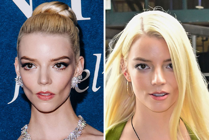 After Anya Taylor-Joy Seemingly Went Back On Her Buccal Fat Removal, Expert Weighs In On Reversal Procedure After Anya Taylor-Joy Seemingly Went Back On Her Buccal Fat Removal, Expert Weighs In On Reversal Procedure