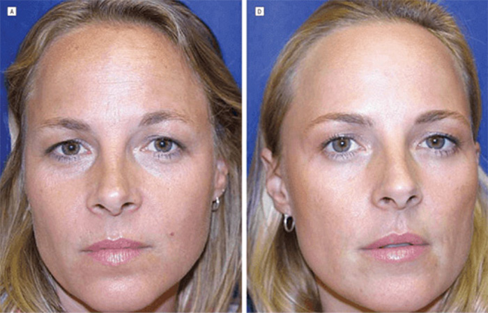 Close-up of identical twins' faces, one showing dramatic differences after using Botox for 20 years. Close-up of identical twins' faces, one showing dramatic differences after using Botox for 20 years.