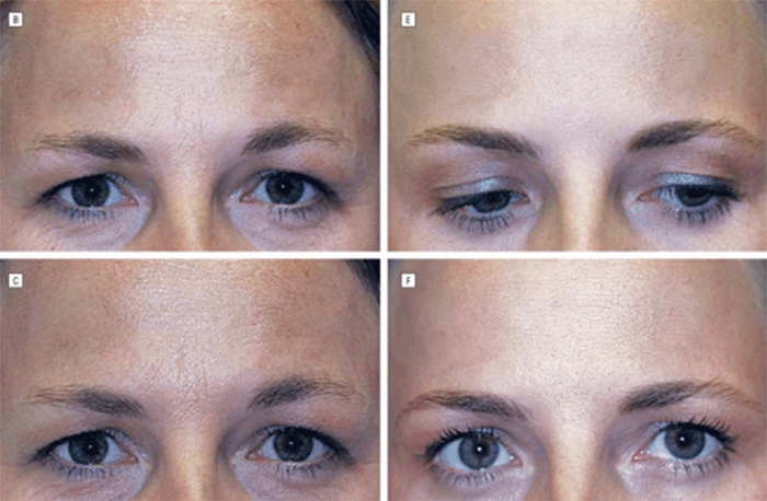 Close-up of eyes showing dramatic differences in identical twins; one used Botox, the other didn't. Close-up of eyes showing dramatic differences in identical twins; one used Botox, the other didn't.