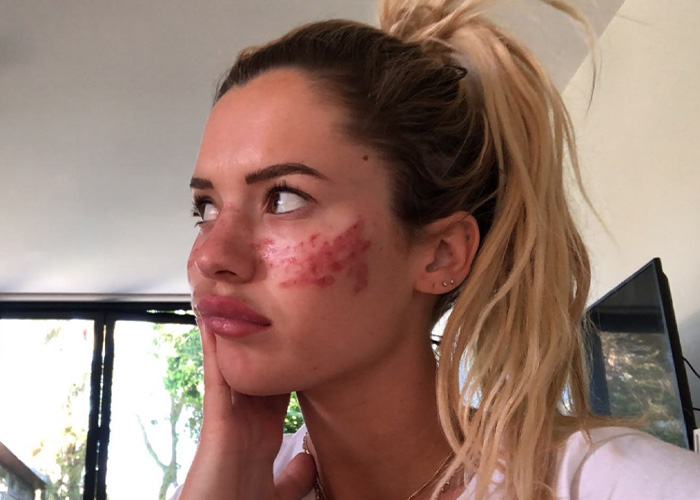 A close-up of a reality star's face, showing red scarring from an attempt at a fake freckle tattooing trend. A close-up of a reality star's face, showing red scarring from an attempt at a fake freckle tattooing trend.