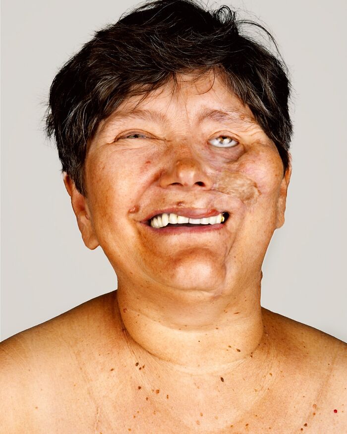 A striking portrait by Brock Elbank of a smiling woman with facial scars, looking beyond appearance to the stories.