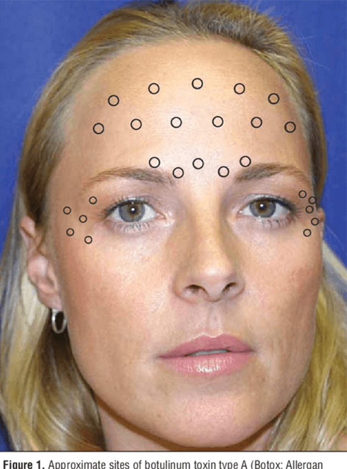 Diagram showing approximate sites for Botox injections on a woman's face to reduce dramatic differences. Diagram showing approximate sites for Botox injections on a woman's face to reduce dramatic differences.