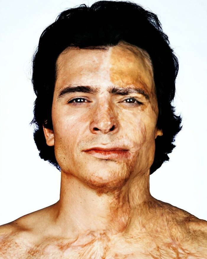 A powerful portrait by Brock Elbank showing a man with burn scars, highlighting the stories behind the faces.