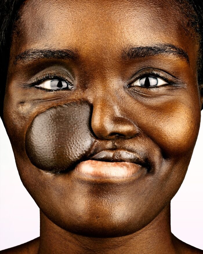 A powerful portrait by Brock Elbank of a smiling Black woman with a facial growth, highlighting the stories behind faces.