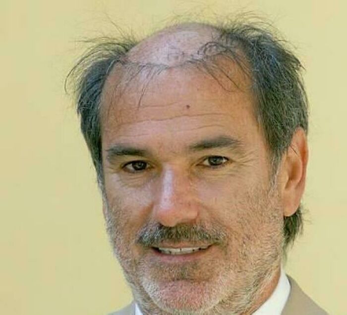 A smiling man with a receding hairline and thin, wispy hair, showcasing a bold and perhaps regrettable hairstyle.