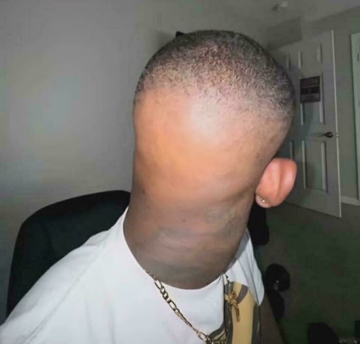 A person with a strikingly smooth, bald head and unique ear placement, showcasing bold hairstyles.