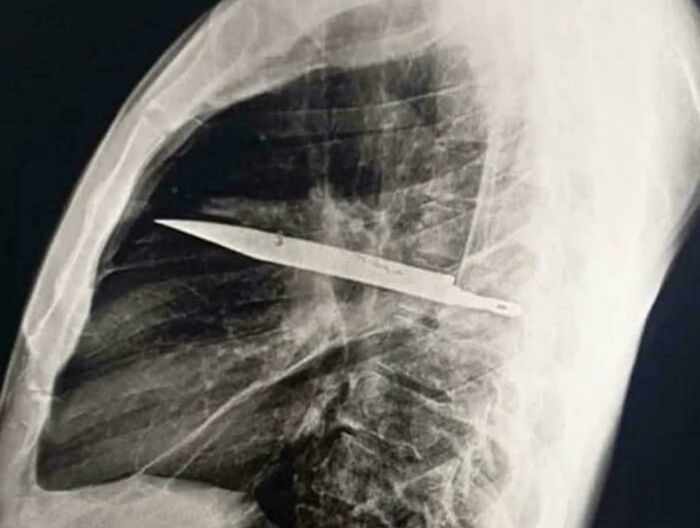 A 44-Year-Old Man Went To The Hospital After Pus Began Oozing From His Chest, Where Doctors Discovered A Knife That Had Been Embedded In His Body For Eight Years. According To The Report, He Showed No Signs Of Chest Pain, Breathing Problems, Coughing, Or Fever, And Was Otherwise In Good Health