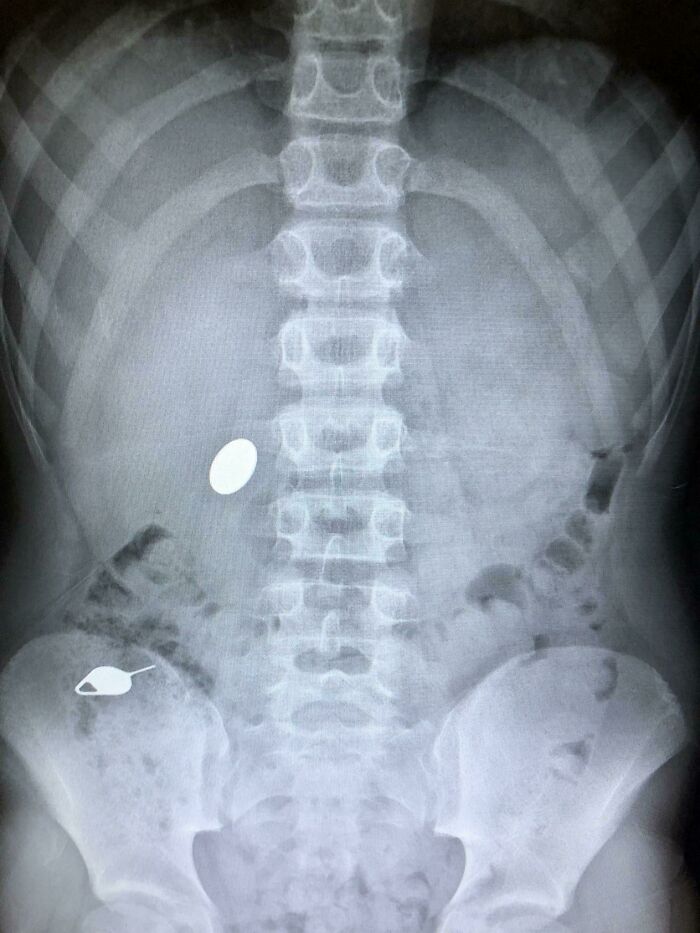 An X-ray of a torso with two foreign objects inside, a surprising discovery for concerned parents.