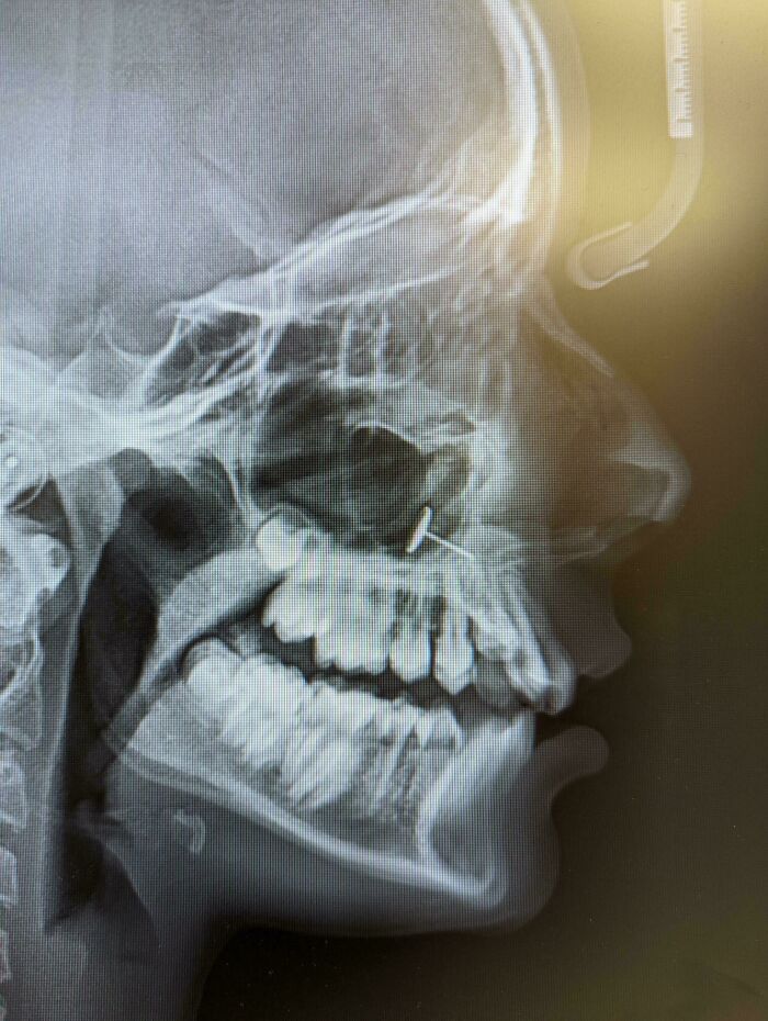 A profile X-ray of a skull showing a foreign object near the teeth, a parental concern.