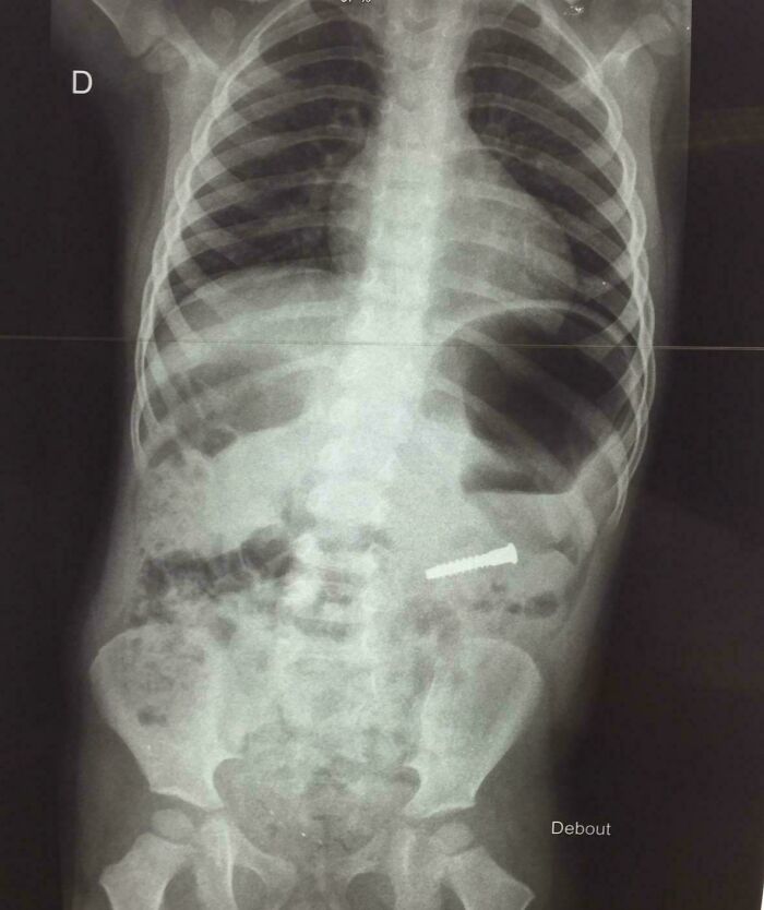 An X-ray of a child's torso, revealing a s***w inside, a common concern for parents.