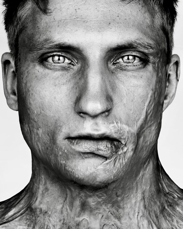 A monochrome portrait by Brock Elbank focusing on a man with prominent facial scars, capturing his personal story.