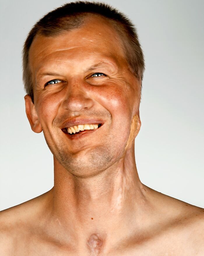 A smiling portrait by Brock Elbank of a man with facial scars, focusing on the stories behind the faces.