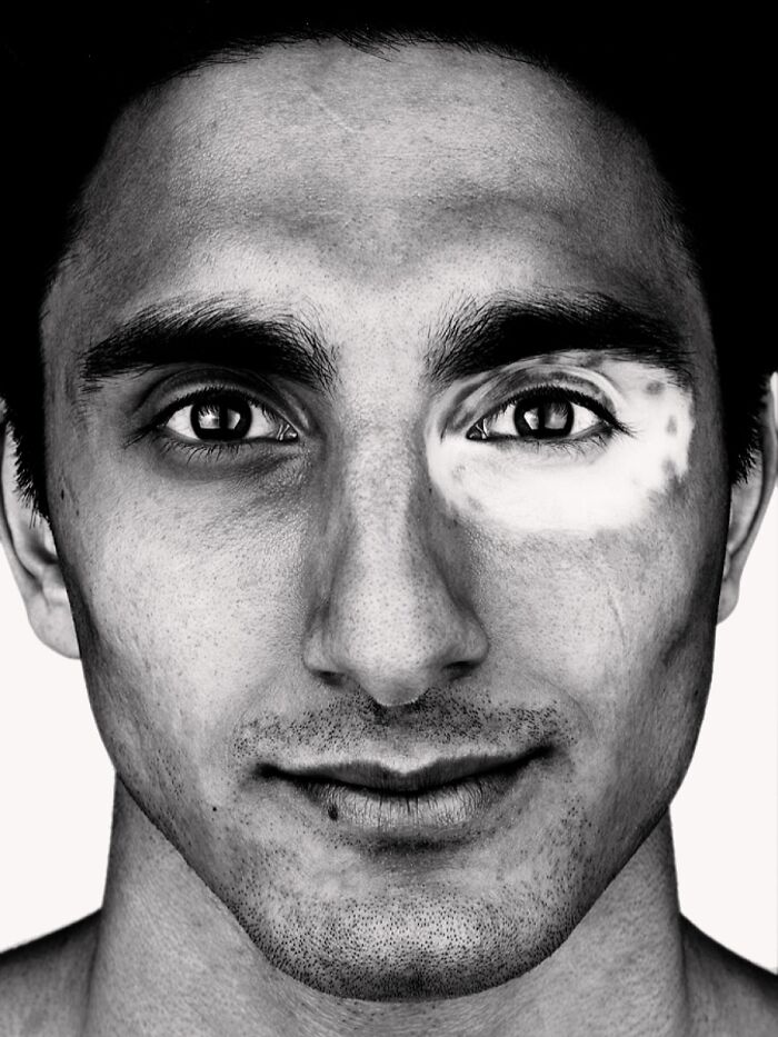 A black and white portrait by Brock Elbank of a man with vitiligo around his eye, showcasing diverse faces.