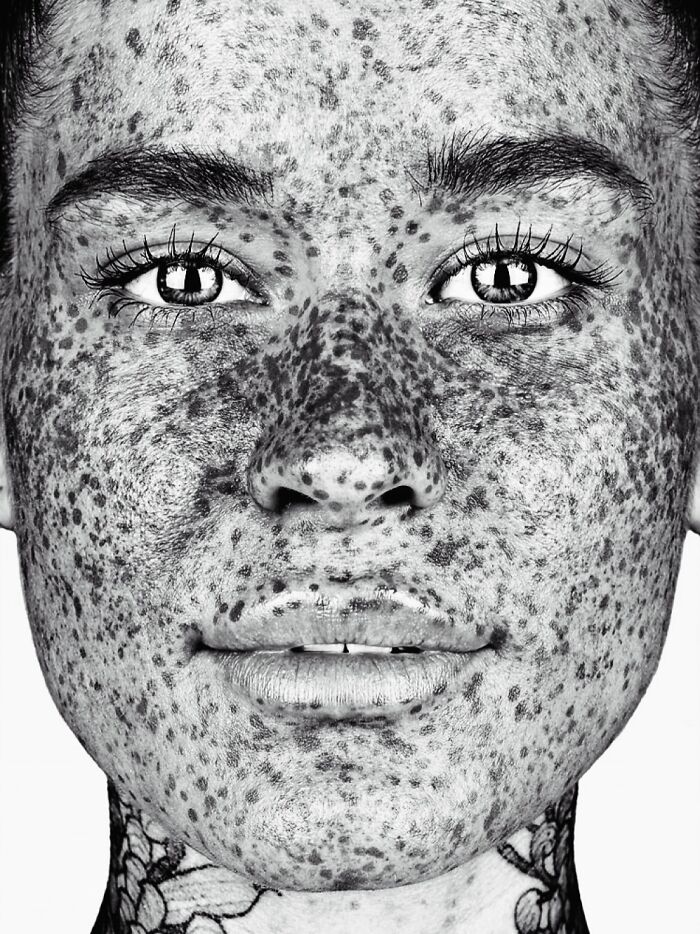 A close-up black and white portrait by Brock Elbank of a person with many freckles, capturing unique faces.