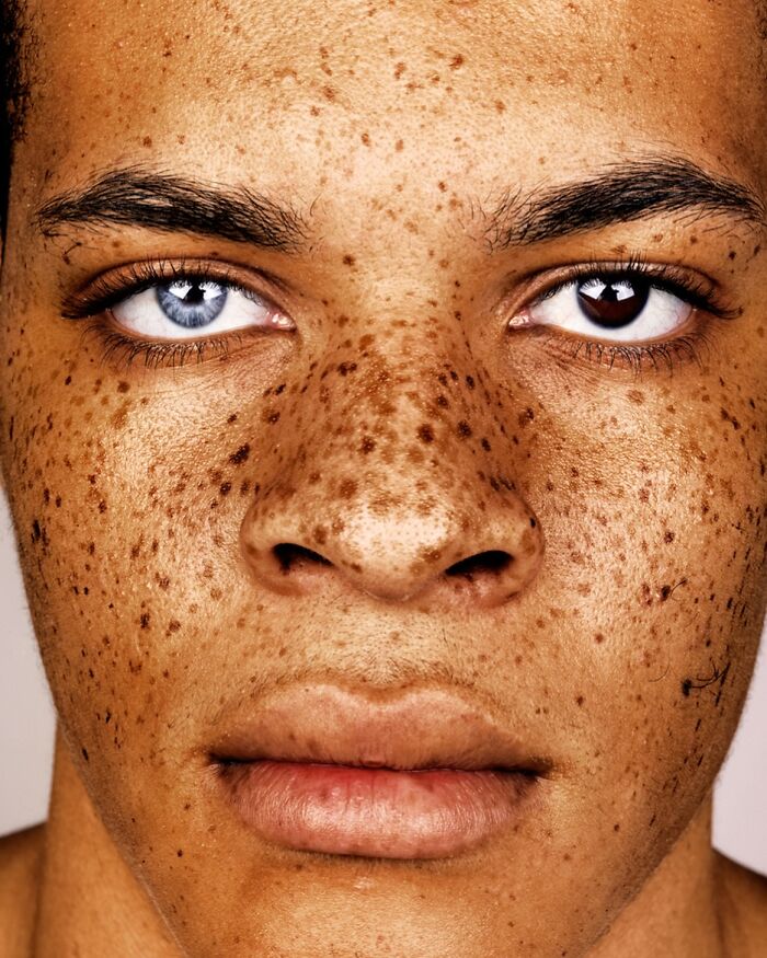 A close-up portrait by Brock Elbank showing a face with freckles and heterochromia, one blue eye and one brown.