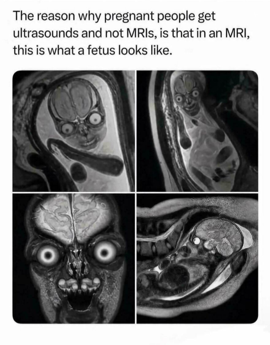 Four MRI scans of a fetus showing disturbing facial features, explaining why ultrasounds are preferred, highlighting strange things on Earth.