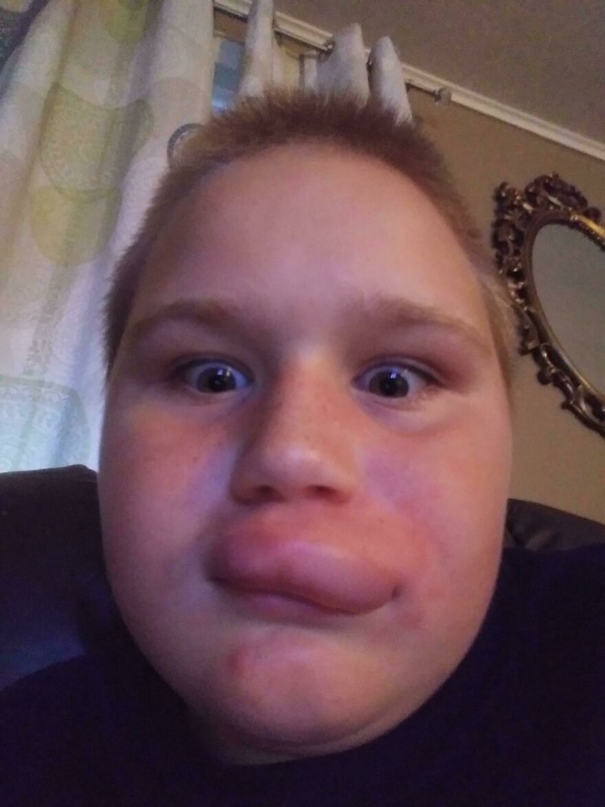 A child with a severely swollen lip after an unfortunate fail, looking surprised and funny.
