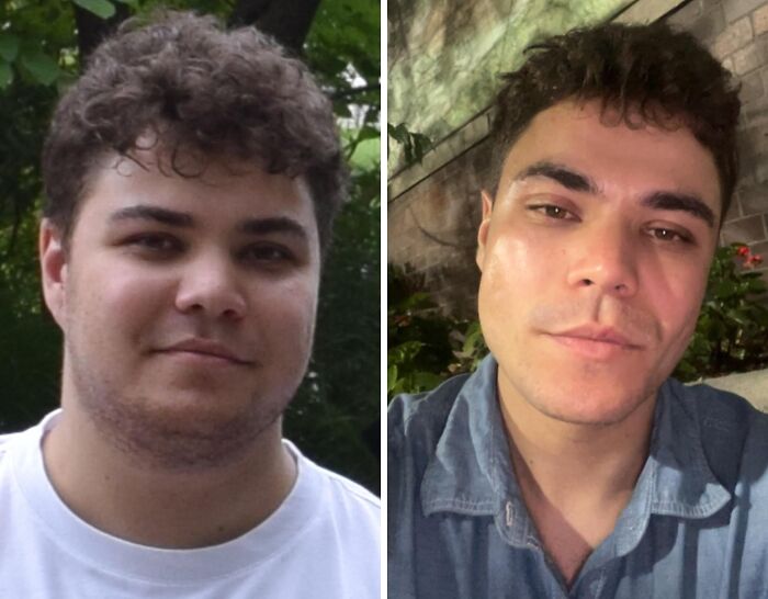 A young man's incredible transformation from an ugly duckling with a fuller face to a chiseled jawline.