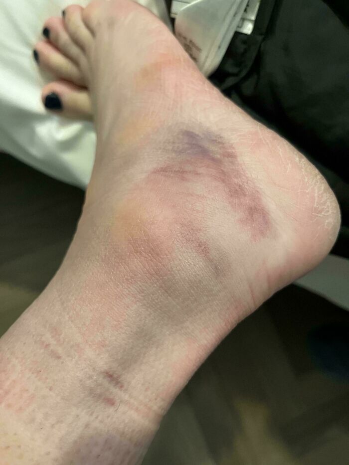 A close-up of a severely bruised and swollen foot, a painful mishap from a trip that didn't go as planned.