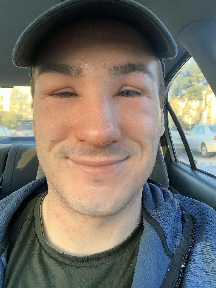 A man with a swollen face and eyes after an allergic reaction, showing people's trips with unforeseen incidents.