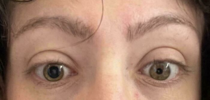 A close-up of a person's eyes, one with an irregularly shaped pupil, an unexpected and interesting moment.