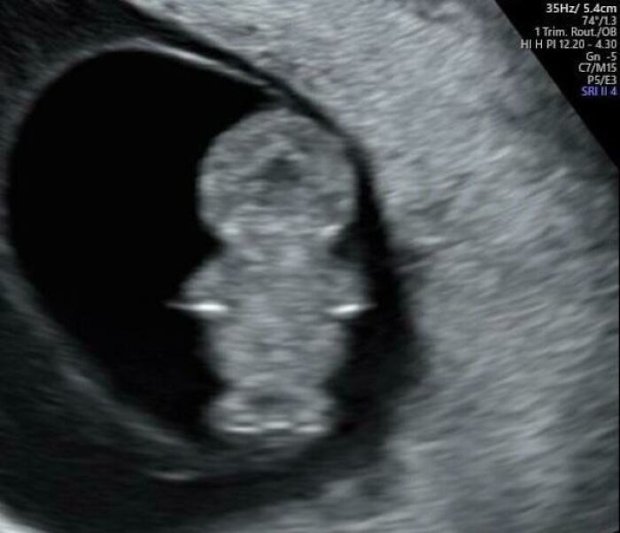 An ultrasound image displaying an unhinged and ridiculous fetal shape, resembling a pig.
