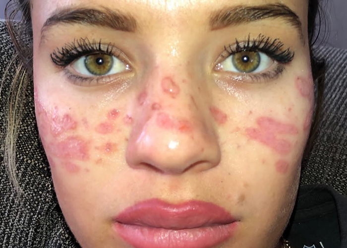 Frontal view of a scarred face, showing widespread skin damage from the tattooing attempt for a viral trend. Frontal view of a scarred face, showing widespread skin damage from the tattooing attempt for a viral trend.