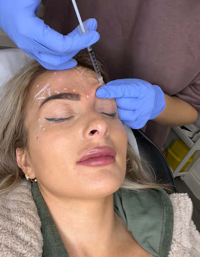 A woman receiving Botox injections on her forehead, part of a comparison showing dramatic differences. A woman receiving Botox injections on her forehead, part of a comparison showing dramatic differences.