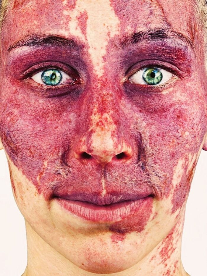 A vibrant portrait by Brock Elbank of a person with a purple and red birthmark on their face, illustrating the stories behind faces.