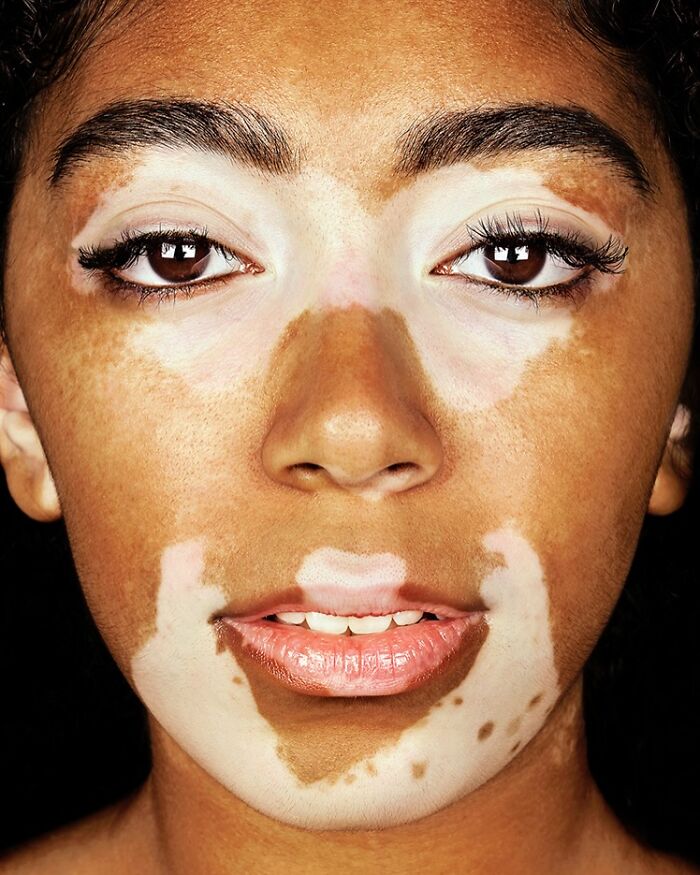A close-up portrait by Brock Elbank of a woman with vitiligo, showcasing the unique beauty and stories behind faces.