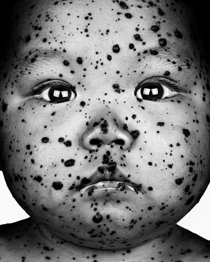 A striking black and white portrait by Brock Elbank of a baby's face covered in dark spots, highlighting the stories behind faces.