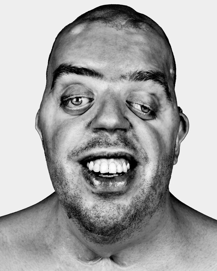 A black and white portrait by Brock Elbank showing a man with unique facial features, emphasizing the stories behind faces.