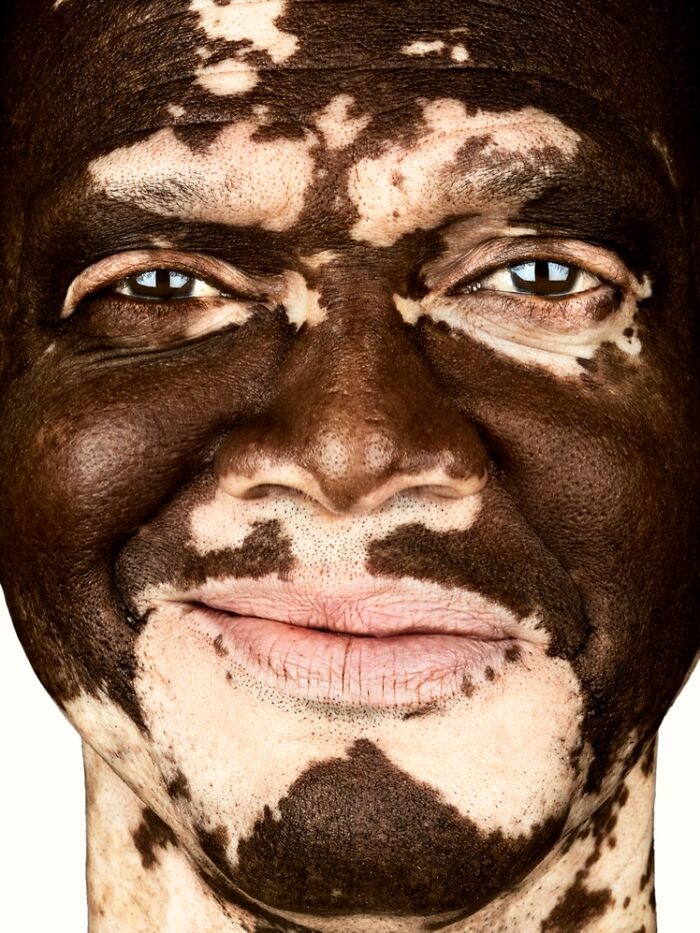 A close-up portrait by Brock Elbank of a person with vitiligo, showcasing the unique patterns on their face, telling a story.