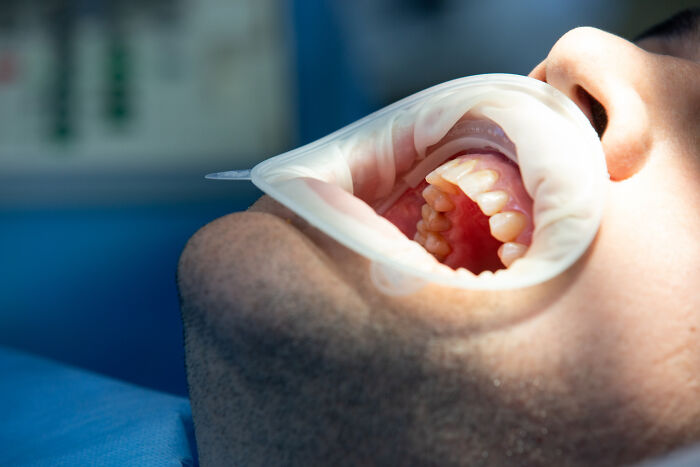 62 Patients Share The Medical Procedures That Hurt Far More Than Doctors Had Led Them To Expect