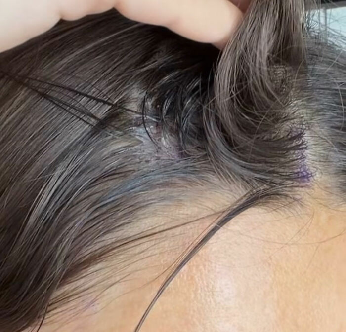How Young Is Too Young To Get A Korean Facelift? Netizens Criticize Influencer's Decision After Recovery Posts How Young Is Too Young To Get A Korean Facelift? Netizens Criticize Influencer's Decision After Recovery Posts