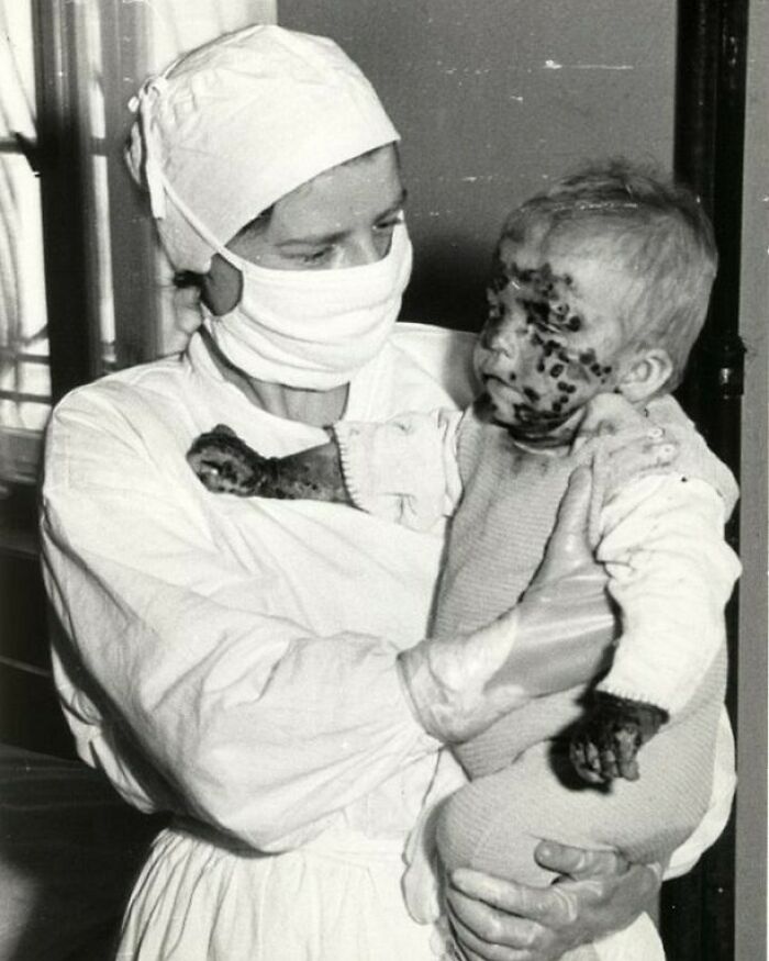 A nurse in a surgical mask and cap holds a baby covered in sores, a moment nearly lost to history.