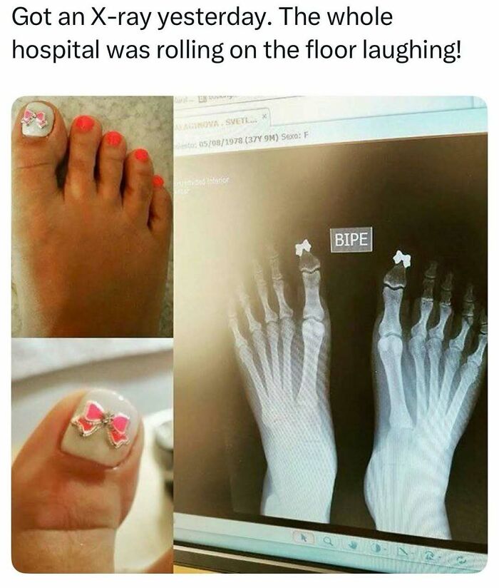 Funny medical meme of an X-ray showing bow decorations on a patient's toes, making the hospital laugh.