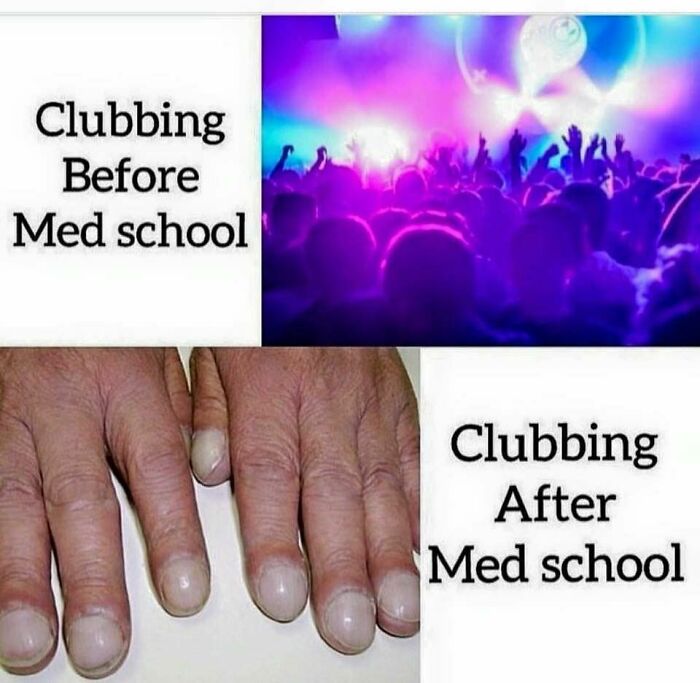 Funny medical meme showing the difference in clubbing before and after med school, with hands appearing diseased afterwards.