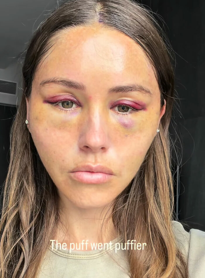 How Young Is Too Young To Get A Korean Facelift? Netizens Criticize Influencer's Decision After Recovery Posts How Young Is Too Young To Get A Korean Facelift? Netizens Criticize Influencer's Decision After Recovery Posts