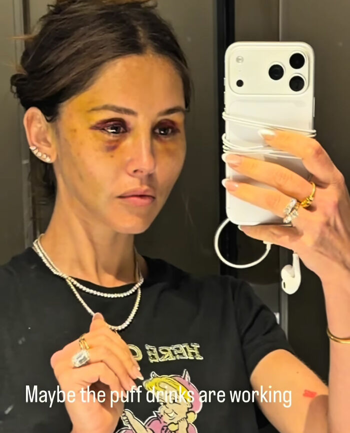 How Young Is Too Young To Get A Korean Facelift? Netizens Criticize Influencer's Decision After Recovery Posts How Young Is Too Young To Get A Korean Facelift? Netizens Criticize Influencer's Decision After Recovery Posts