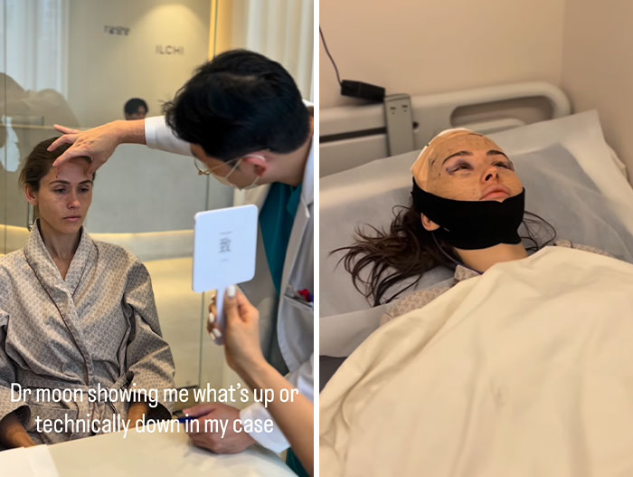 How Young Is Too Young To Get A Korean Facelift? Netizens Criticize Influencer's Decision After Recovery Posts How Young Is Too Young To Get A Korean Facelift? Netizens Criticize Influencer's Decision After Recovery Posts