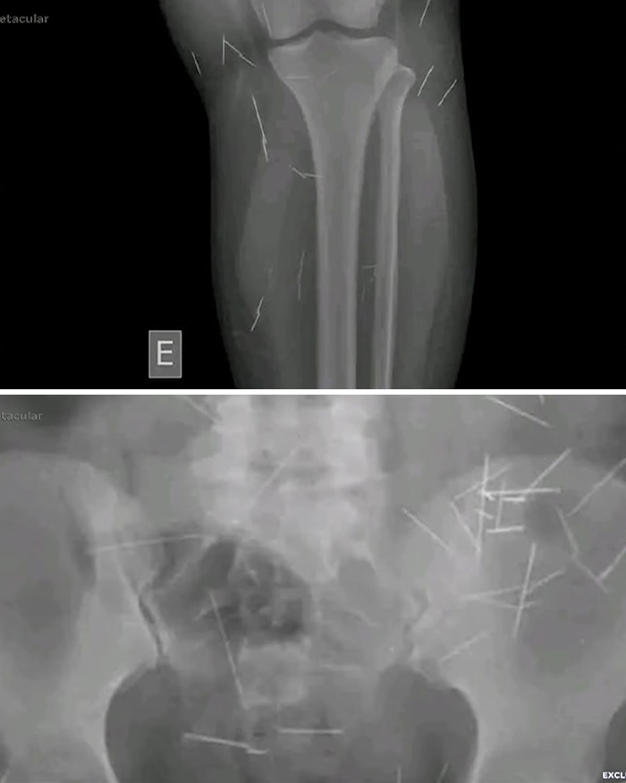 X-rays showing multiple needle-like objects embedded in the body of the 38-year-old woman.