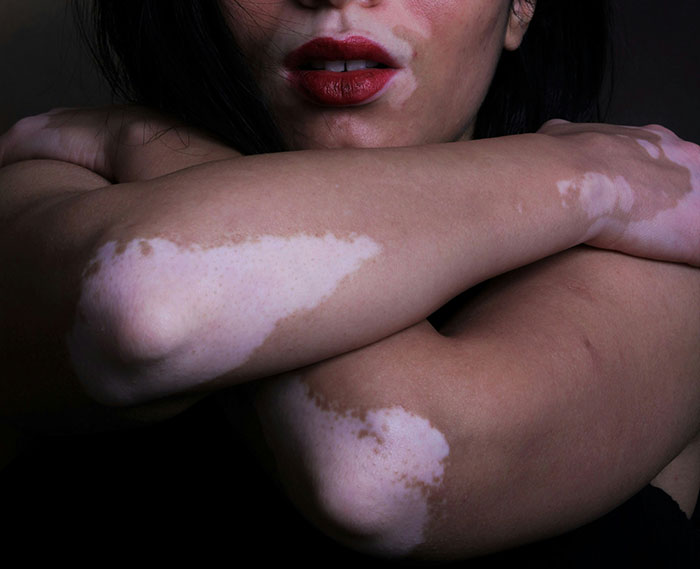 A woman with vitiligo embracing her arms, highlighting the skin condition.