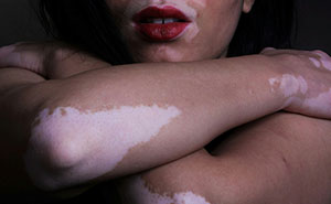 Guy’s Mom Makes His GF’s Vitiligo Her Favorite Insult, Stops Laughing When She Develops It Herself
