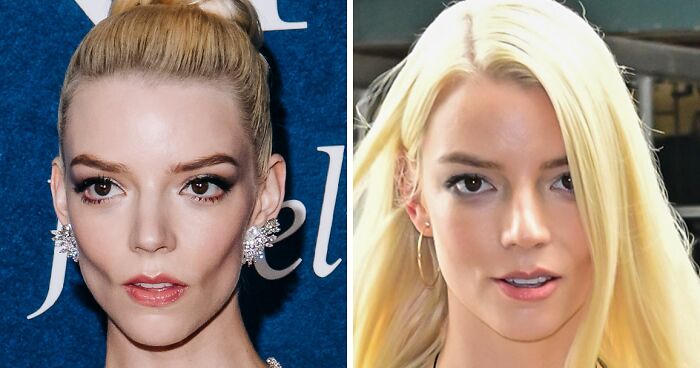 After Anya Taylor-Joy Seemingly Went Back On Her Buccal Fat Removal, Expert Weighs In On Reversal Procedure