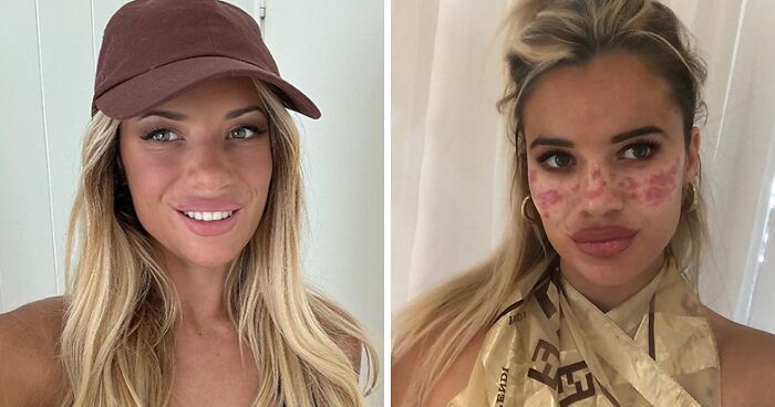 Reality Star Launches Fake Freckle Brand After Attempt At Tattooing Her Own Face For Viral Trend Left Her Scarred