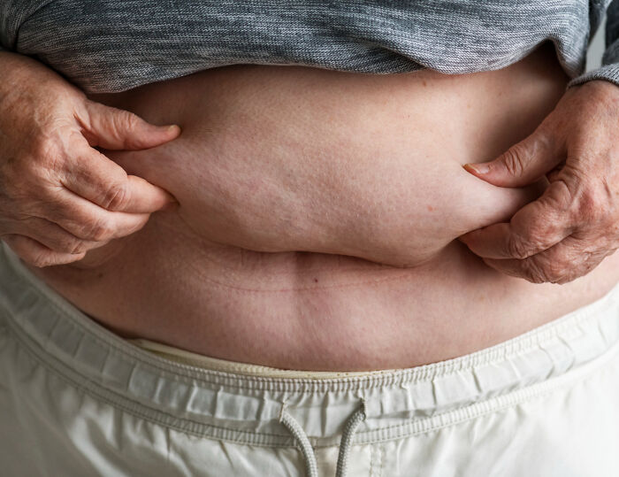 Hands pinch a roll of belly fat, an example of something patients have said to doctors that makes no sense.