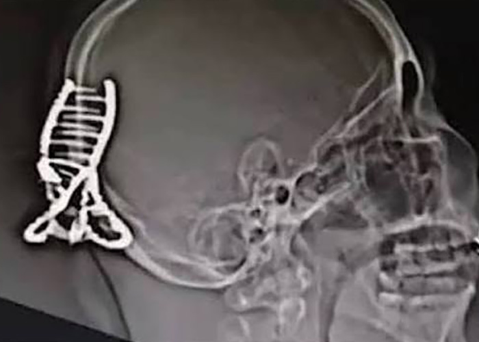 X-ray of a skull showing a hair accessory embedded, highlighting life-threatening injuries.