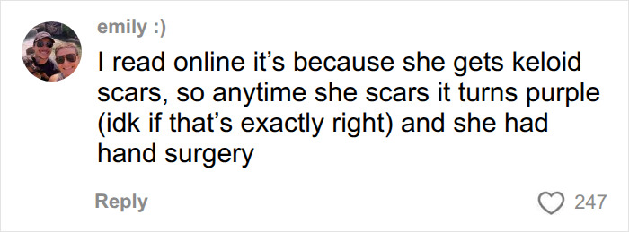 Emily's comment about Dolly Parton's tattooed hands and skin-colored gloves, hiding keloid scars and hand surgery. Emily's comment about Dolly Parton's tattooed hands and skin-colored gloves, hiding keloid scars and hand surgery.