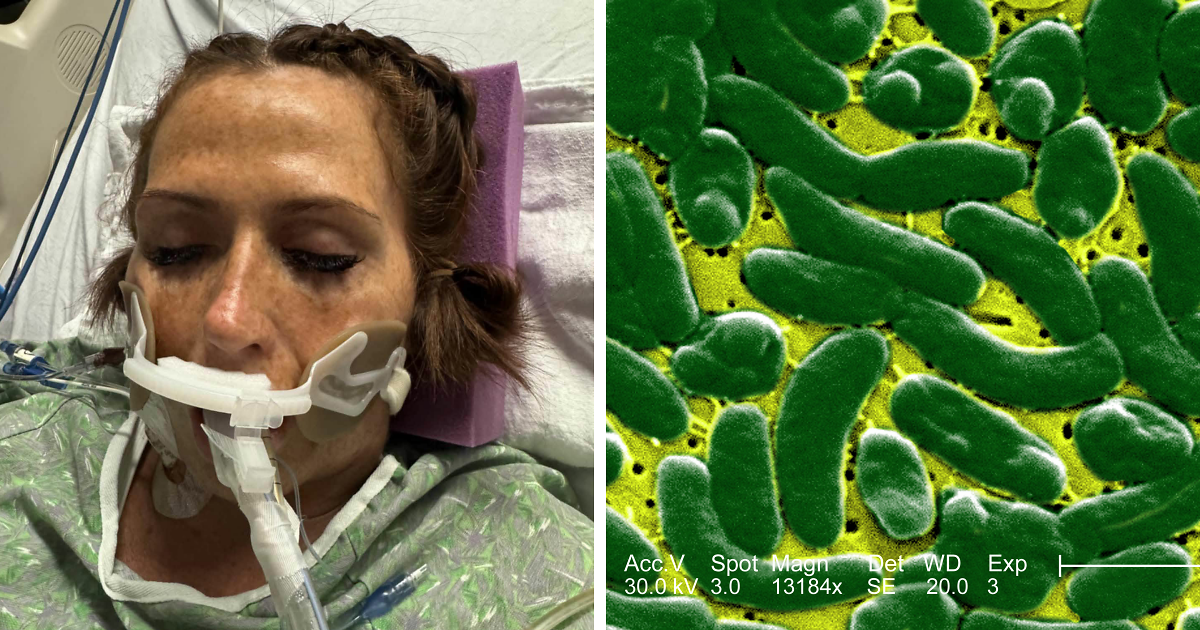 Woman Who Lost ‘A Lot Of My Leg’ To Flesh-Eating Bacteria Warns Women About Common Pre-Swim Habit - Bored Panda